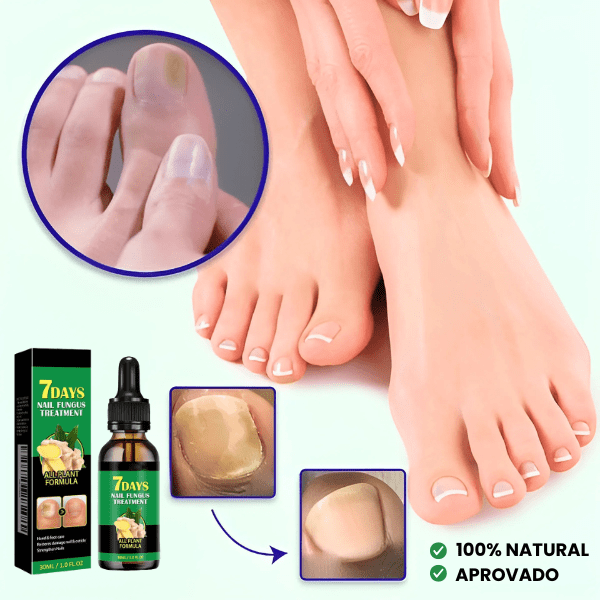 TRATAMENTO ANTI-FUNGOS 7 DIAS 100% NATURAL